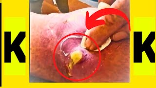 Top 3 Most Satisfying Pimple popping and Blackhead Removal compilation😜popping acne pimplepopping [upl. by Htrap]