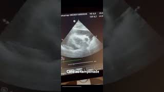 Cardiac tamponadecardiology echocardiography science medicine ultrasound [upl. by Denney]