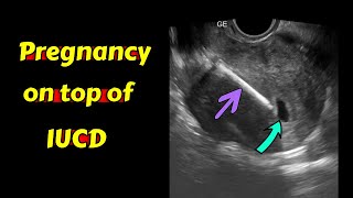 Pregnancy on top of IUCD  Ultrasound Case [upl. by Rimaa]