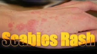 Scabies Rash itchy highly contagious skin disease  Usapang pangkalusugan [upl. by Karisa]