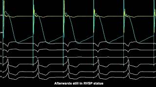 A case of conversion of proposed proximal LBBP to leftsided HBP [upl. by Aicissej]