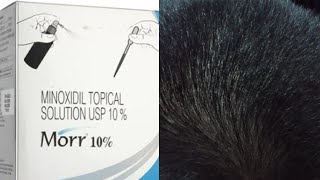 Minoxidil Before and after results  Minoxidil Morr f 10 [upl. by Latsyk848]