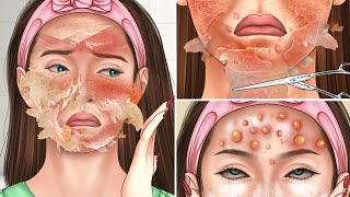 ASMR Acne scar Chemical Peel and Face Massage Full Process Treatment Animation [upl. by Ennovyhc157]