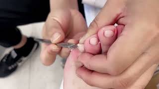 satisfying ingrown toenail removal 010 [upl. by Annuaerb]