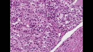 Histopathology KidneyRenal cell carcinoma [upl. by Markland]