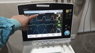 NIV Ventilator Settings  COVID19 Pneumonia ventilator settings in hindi [upl. by Uttasta]