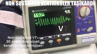 NON SUSTAİNED VENTRİKÜLER TAŞİKARDİ [upl. by Ihsir]