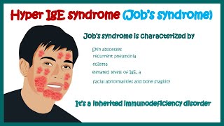 Hyper IgE syndrome Jobs syndrome   Immunodeficiency disorder  clinical features [upl. by Kirkwood]