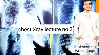 CHEST XRAY LECTURE NO 2 FOR ALL MEDICAL STUDENTS  HOW TO READ CHEST XRAYchestxray [upl. by Yseult]