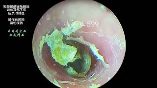 Hard cerumen removal dry pieces on the ear canal and eardrum [upl. by Assener852]