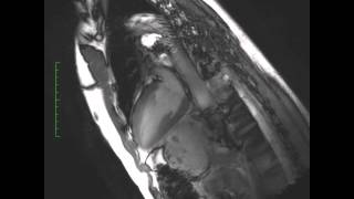 Coronary Angiography CAG Procedure  Deepak Heart institute [upl. by Letnom]