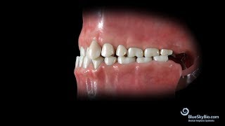 Anterior Crossbite Skeletal or Functional [upl. by Lune62]