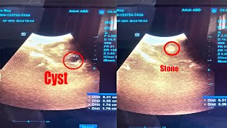 Left Renal Stone Nephrolithiasis with Left Renal Cyst ScanningDiagnosis in Ultrasonography [upl. by Brunelle]