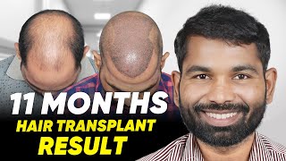 Hair Transplant in Lucknow  Best Results amp Cost of Hair Transplant in Lucknow [upl. by Westley]