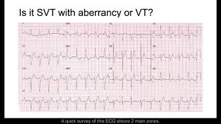 SVT with Aberrancy or VT [upl. by Edrea]