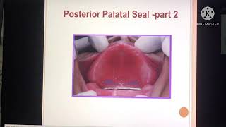 Posterior palatal seal area Part 2 topic 1 [upl. by Burgwell]