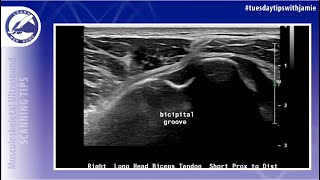 Biceps Tendon Rupture Shoulder Ultrasound Protocol [upl. by Rezeile]