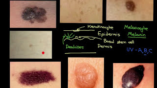 Melanocytic Lesions Part 1 [upl. by Ydniahs]