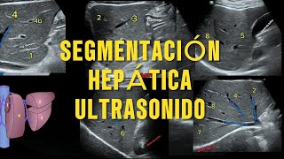 Segmentación Hepática de Couinaud por Ultrasonido La Guía Esencial para Radiología [upl. by Retsehc82]