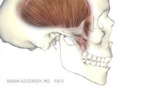 Temporalis Tendon Transfer  Facial Paralysis Surgery [upl. by Refennej]