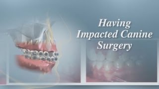 Having Impacted Canine Surgery [upl. by Case404]