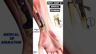 Depuy S3SNP 10 Surgical Technique Medical 3D Animation short biology With Aliya [upl. by Korwin]