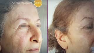 Dr Angela Rahm watch her 3rd Tixel AntiAging Facial Procedure [upl. by Zumwalt]