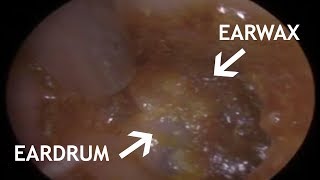 EARDRUM EAR WAX REMOVAL  STEADY HAND PREREQUISITE  439 [upl. by Eniretac]