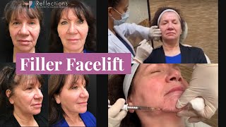 Merriannes Transformation ChinFiller amp LiquidFacelift with Dr WixHarris [upl. by Einalem375]