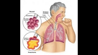 Probiotics Bifidobacterium Breve amp Lactobacillus Rhamnosus Helps Asthma  Inflammation T cell [upl. by Aleb]