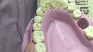 Class 1 Lower 7 cavity preparation for amalgam restoration  عربي [upl. by Gotcher713]