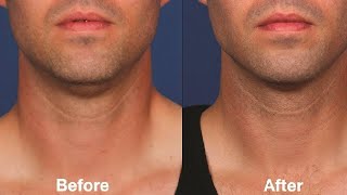 how to get rid of sagging jowls naturally at home [upl. by Aiyn]