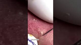 Blackheads Removal  Acne Treatment and Very Satisfying Satisfying Pimple pop blackheads [upl. by Matusow]