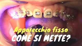 Come si mette lapparecchio fisso [upl. by Uttasta]