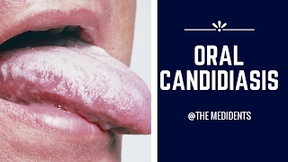 Oral Candidiasis [upl. by Syxela818]