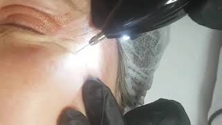 Phiion eyelid lifting treatment [upl. by Curson389]