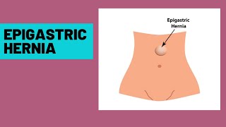 Epigastric hernia  symptoms clinical features [upl. by Henning]