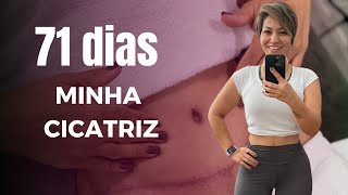 ABDOMINOPLASTIA E MASTO 71 DIAS PÓS OPERATÓRIO  15 [upl. by Billen13]