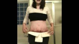 Tummy Tuck Video 4 4 Weeks Post Op [upl. by Petronia258]