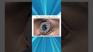 How LASIK Eye Surgery Corrects Vision Problems A StepbyStep Guide [upl. by Airda358]