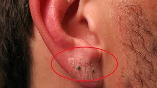 how to get rid of ear piercing infection [upl. by Oicneconi]