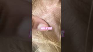 Nits on hair l lice removal service explore hairtok headlice hair [upl. by Rehpoitsirhc]