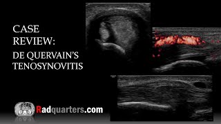 Ultrasound of de Quervain’s Tenosynovitis [upl. by Brogle]