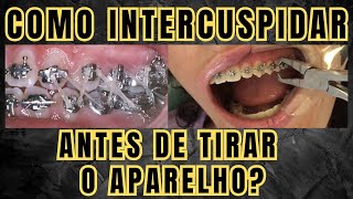 Como fazer a intercuspidação antes de remover o aparelho ortodôntico Aula 211 [upl. by Abebi775]