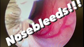 Nosebleeds epistaxis causes prevention treatments and more [upl. by Odelia]