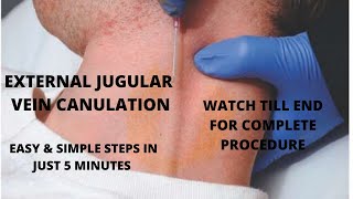 EXTERNAL JUGULAR VEIN CANNULATION PROCEDURE WITH SIMPLIFIED STEPS [upl. by Ayekam9]