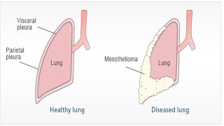 Pleural Mesothelioma  Asbestosis Symptoms and Treatment  Malignant Peritoneal Mesothelioma [upl. by Elatsyrk]