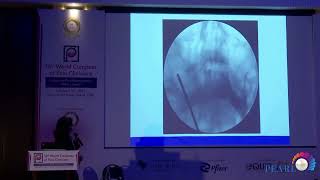 Percutaneous Interventions on Sphenopalatine and Gasserian Ganglion for Orofacial Pain [upl. by Myna]