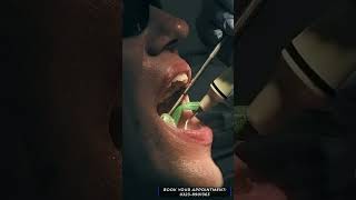 Scaling and polishing for Yellow Teeth  Dr Ayesha Zubair [upl. by Carmella650]