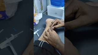 Dry Needling fr Ankle Sprain acupuncture fitness doctor health physiotherapist painrelief [upl. by Orlina730]